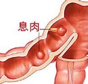 什么是直肠息肉？