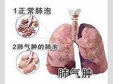 什么是肺气肿？